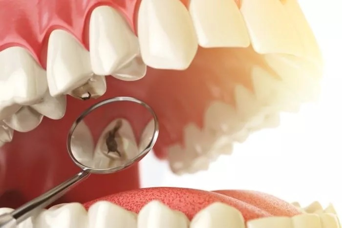 The Reasons Behind the Formation of Cavities and Ways to Prevent Them