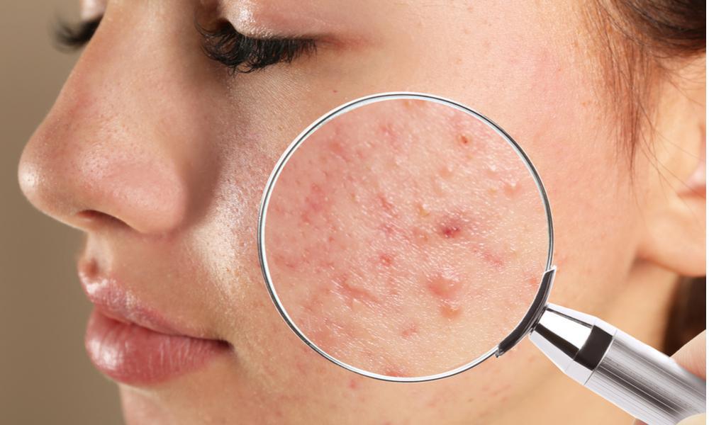 What Are The Causes Of Acne?