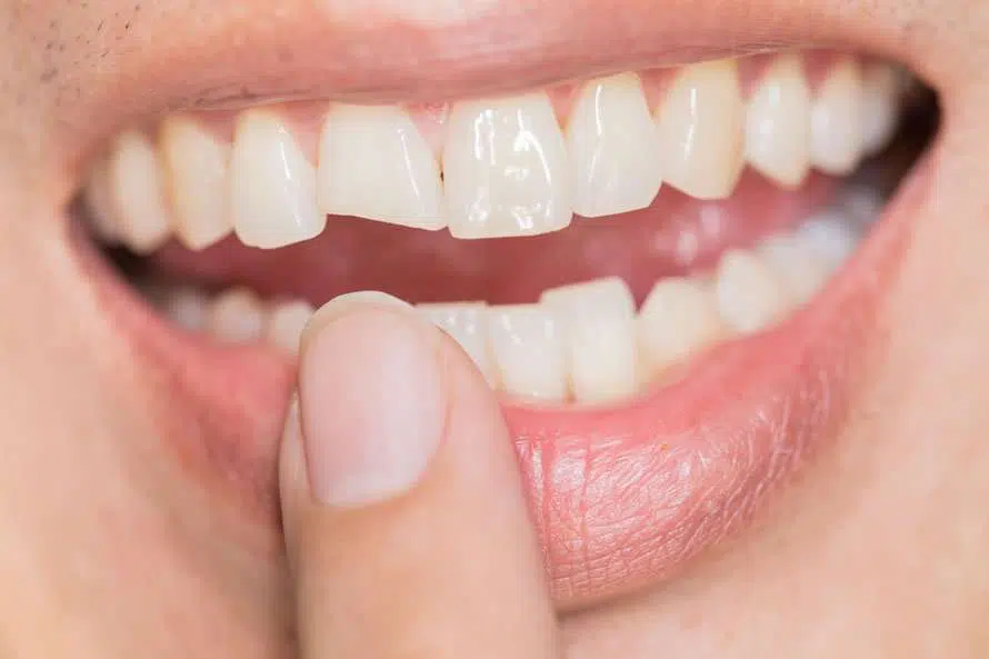 Mending The Gaps: Restoring Your Broken Tooth