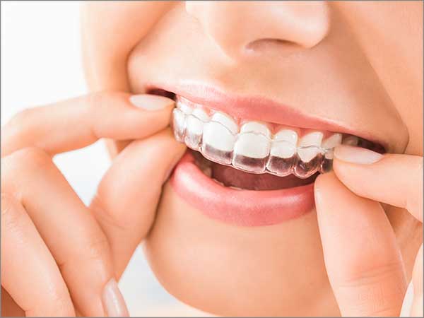 Invisalign -What You Need to Know Before Getting Started