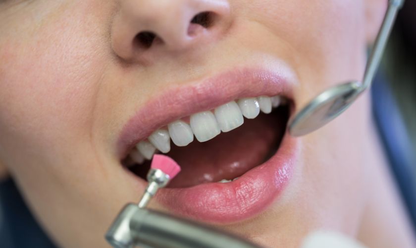 The Aesthetic Advantage: Why Choose Composite Fillings for Front Teeth