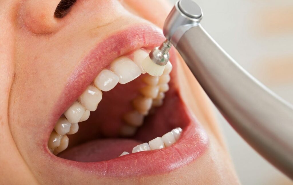 The Frequency of Teeth Cleanings —How Frequently Should You Get Them?