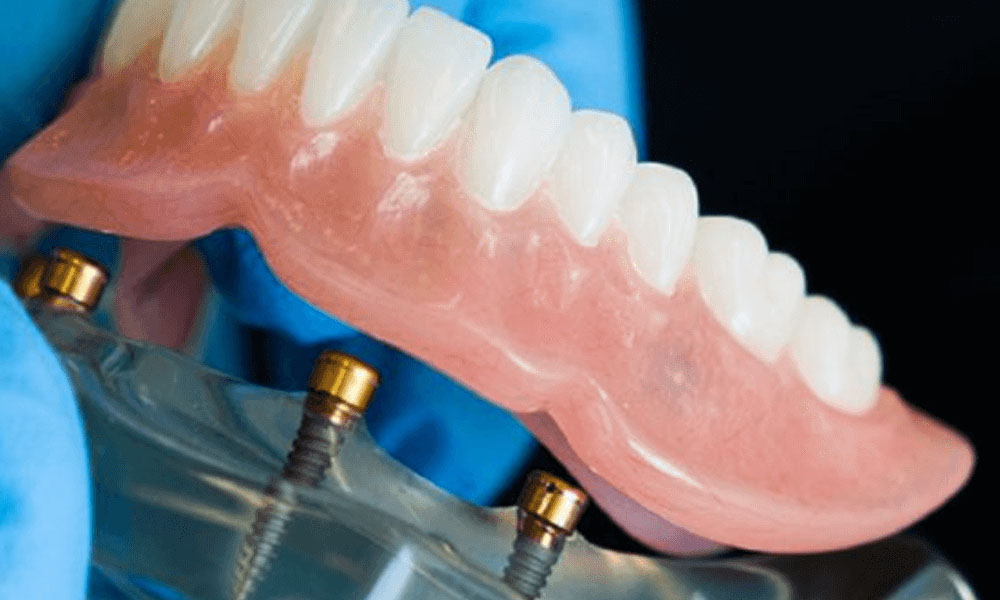 Things You Need To Know About Implant Overdentures